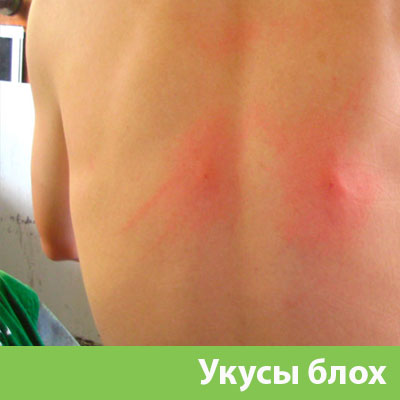 Укусы блох в Камышине