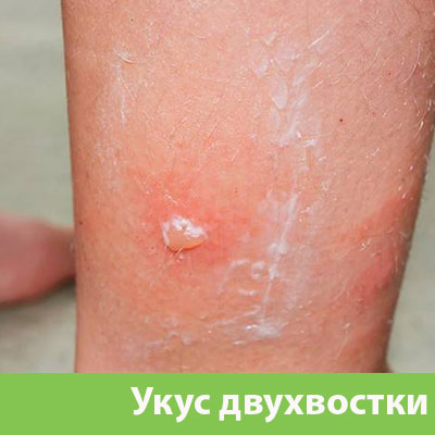 Укус двухвостки в Камышине