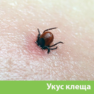 Укус клеща в Камышине