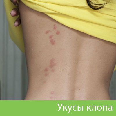 Профессиональное уничтожение клопов в Камышине